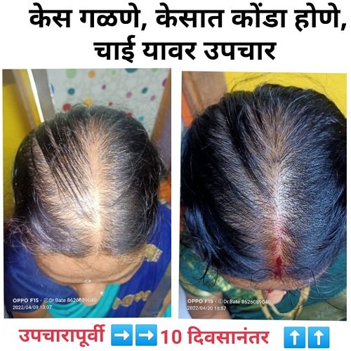 Hair Diseases