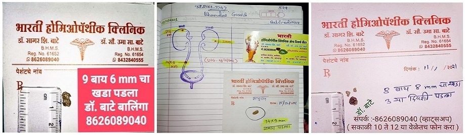 Kidney Stone
