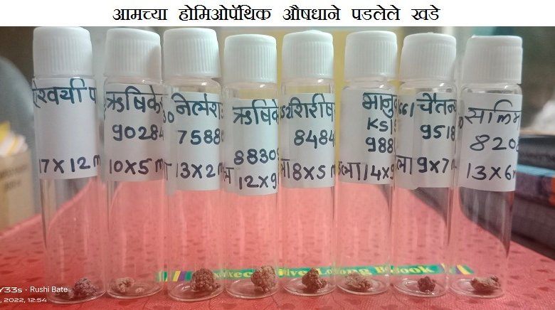 मुतखडा