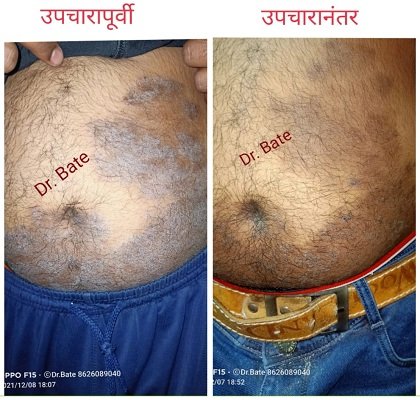 Skin Diseases