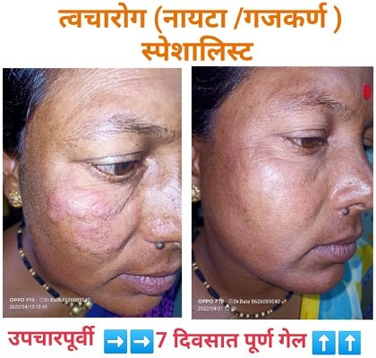 Skin Diseases