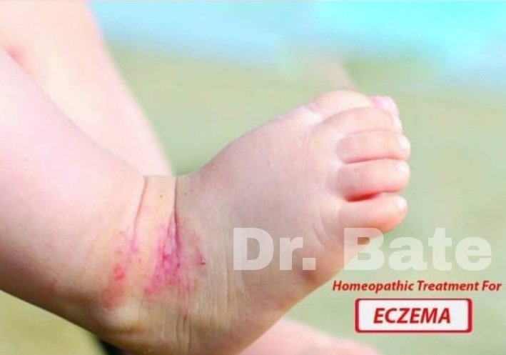 Eczema